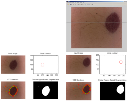 Figure 13 - Solutions for segmentation on skin images. On left automatic solution, on right semi-automatic solution 